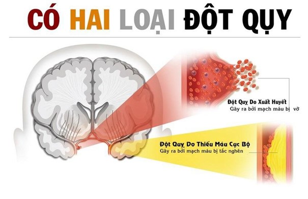 Người lớn tuổi cần lưu ý gì để tránh đột quỵ trong mùa lạnh?